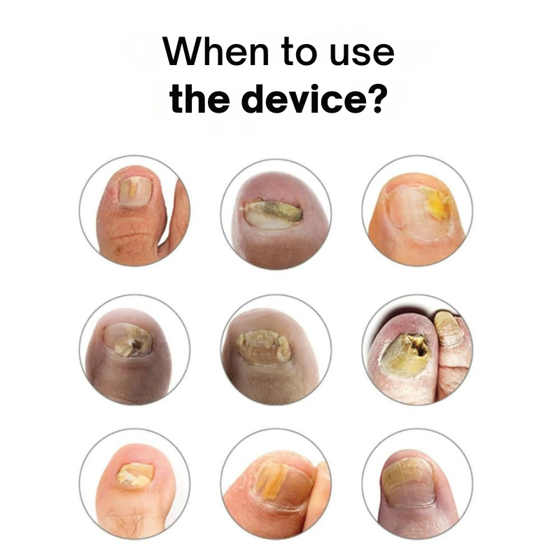 Dispositivo antimicosis - Uñas sanas y protegidas 